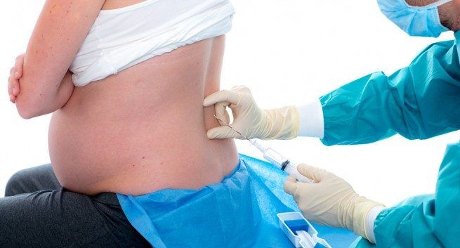 Epidural en el parto beneficios y opciones de anestesia para embarazadas